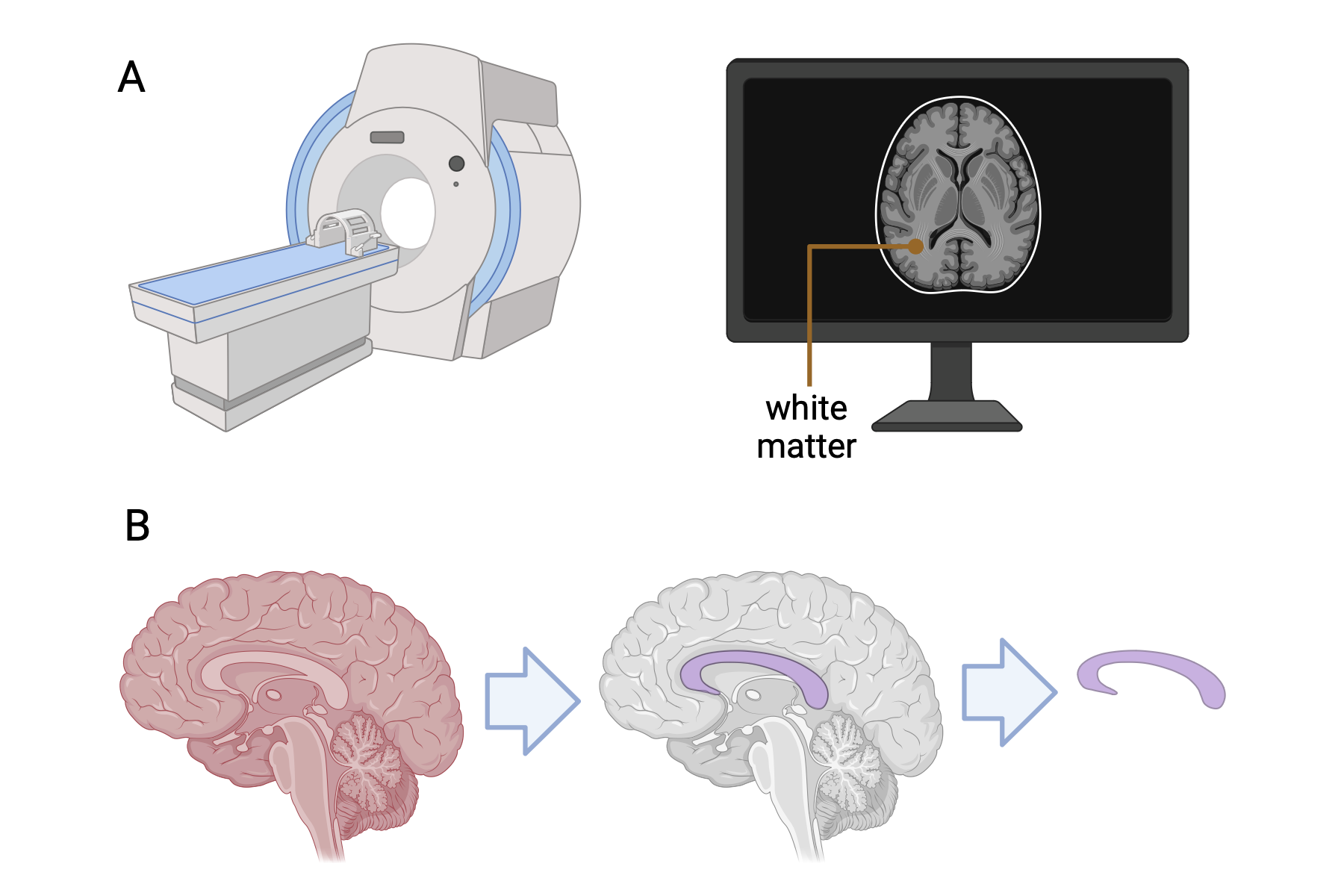 Volumetric quantification of white matter in brain. A. Magnetic Resonance Imaging (MRI) machine (left) and an MRI of the brain, demonstrating white matter (right). B. A schematic of AI-based segmentation process of a major white matter tract.