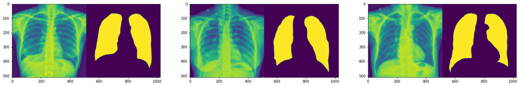 Medical imaging segmentation